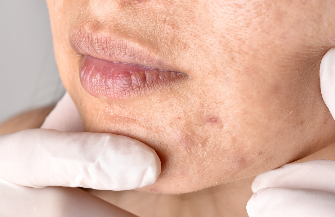 Cum tratăm cicatricile post-acneice