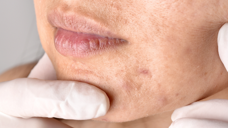 Cum tratăm cicatricile post-acneice