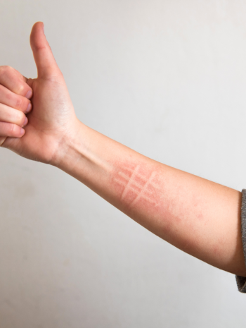 dermatografism